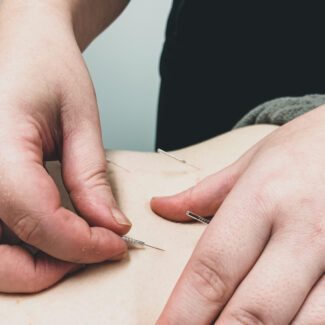 This image shows a close up shot of a client receiving dry needling on their back. There are 4 needles in their lower back and the practitioner is adjusting one to get the trigger point.