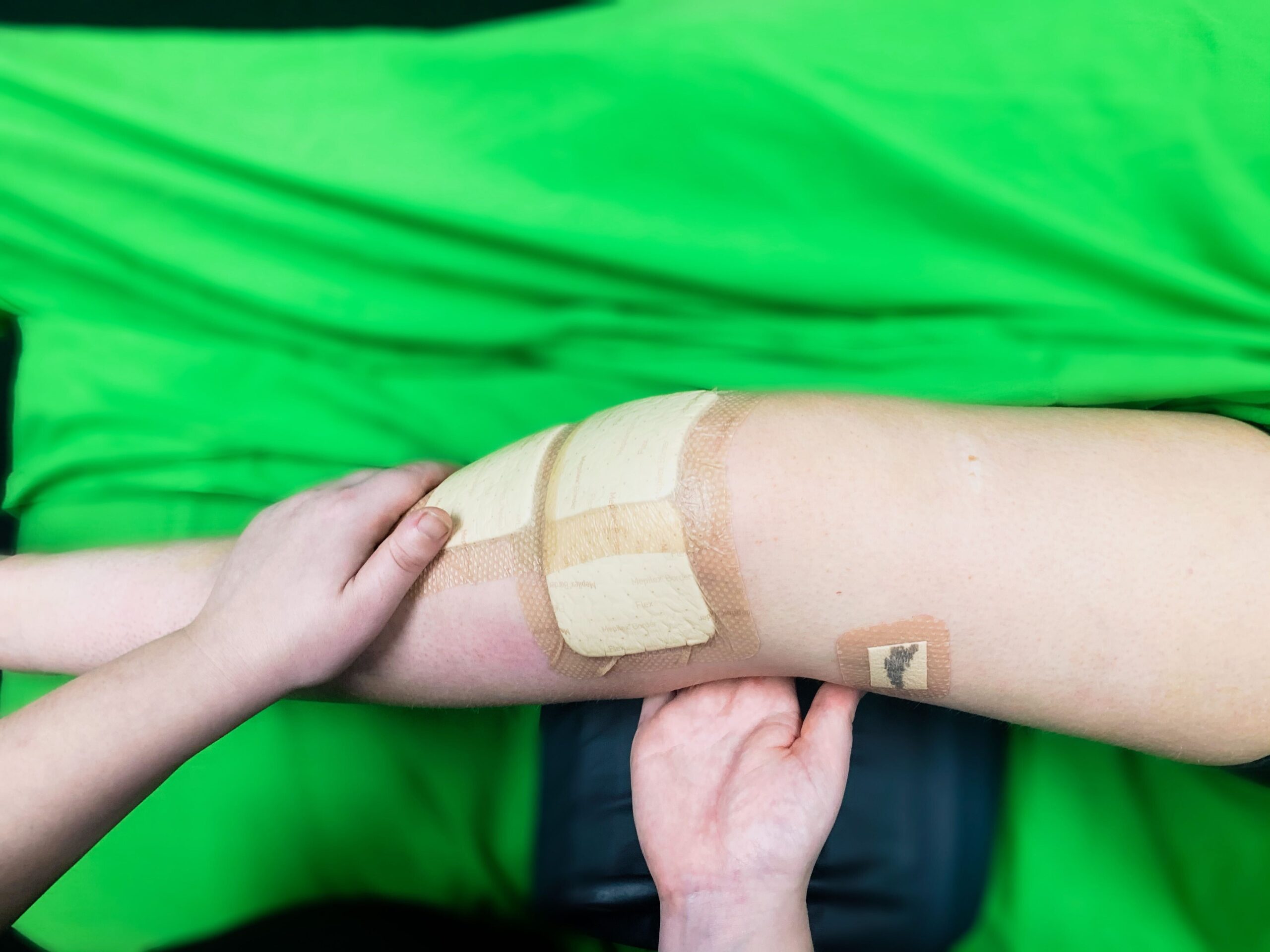 This image shows the leg of a client who is recovering from surgery on their ACL. Their knee has bandages and a practitioner is assessing their range of movement.