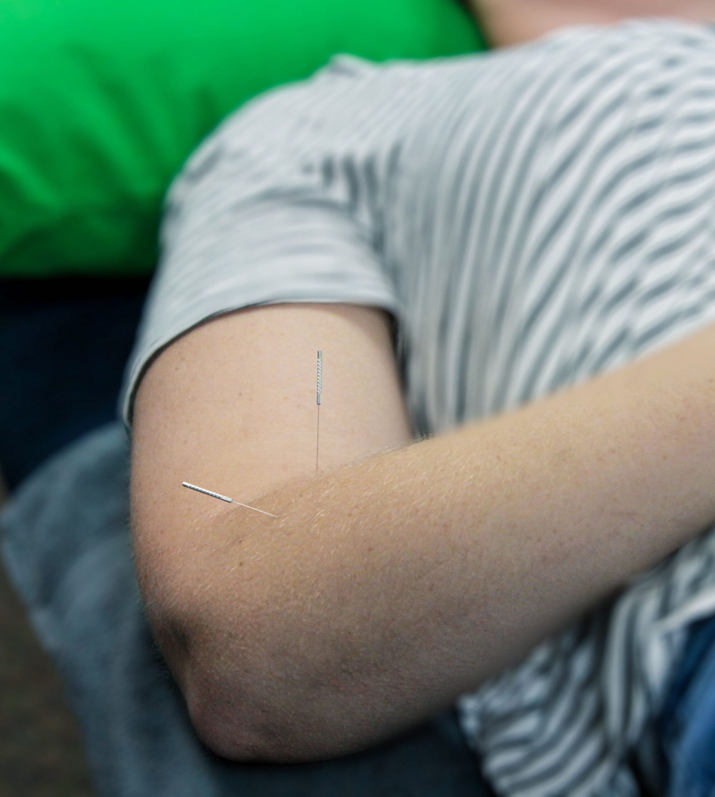 This image shows a client with tennis elbow receiving a dry needling treatment. There are 2 dry needles just below the clients elbow.